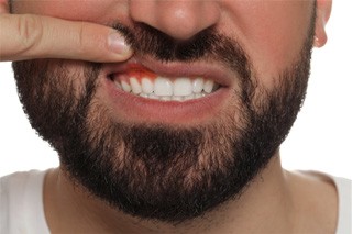 Man pulling up his lip showing signs of gum disease in The Colony, TX