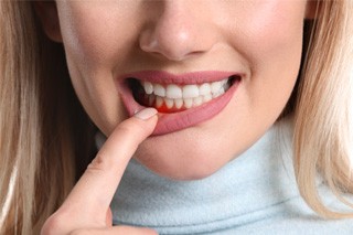 Woman pulling down lip to show swollen gums