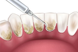 Illustration of scaling and root planing being performed on back of teeth