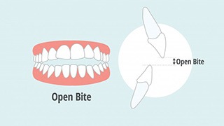 Illustration of open bite