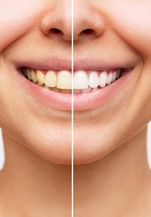 Side-by-side before and after of a cosmetic dental treatment